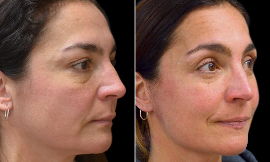 Blepharoplasty Surgery Results