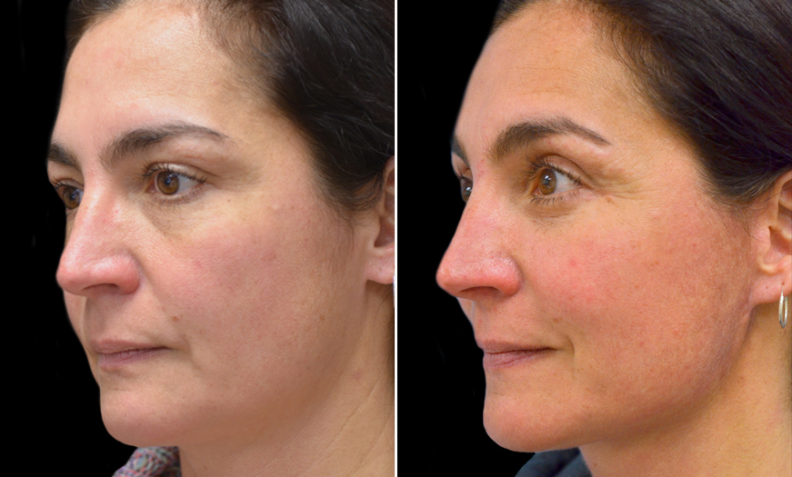 Blepharoplasty Before and After Photo