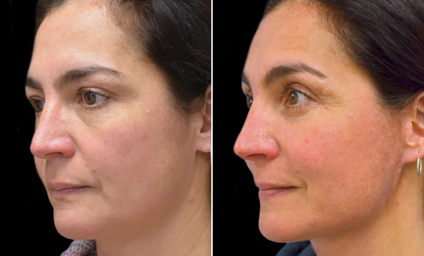 Malar Bags Treatment Before and After in NJ