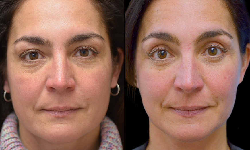 Facelift Before and After