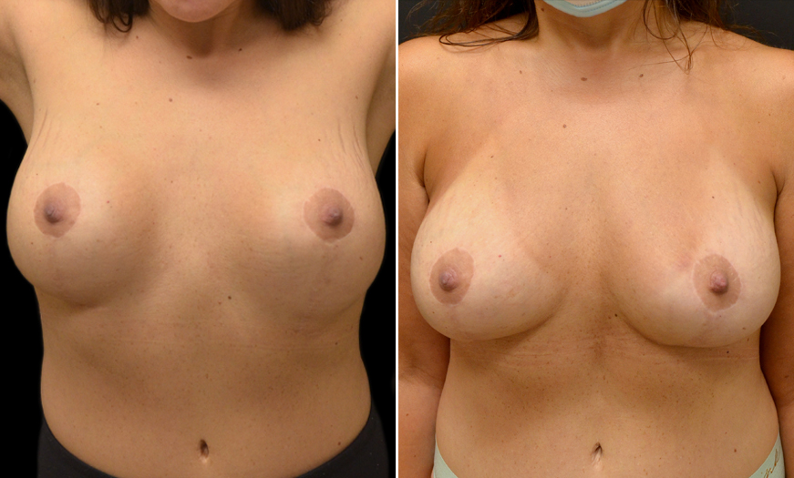 Breast Reduction Before and After