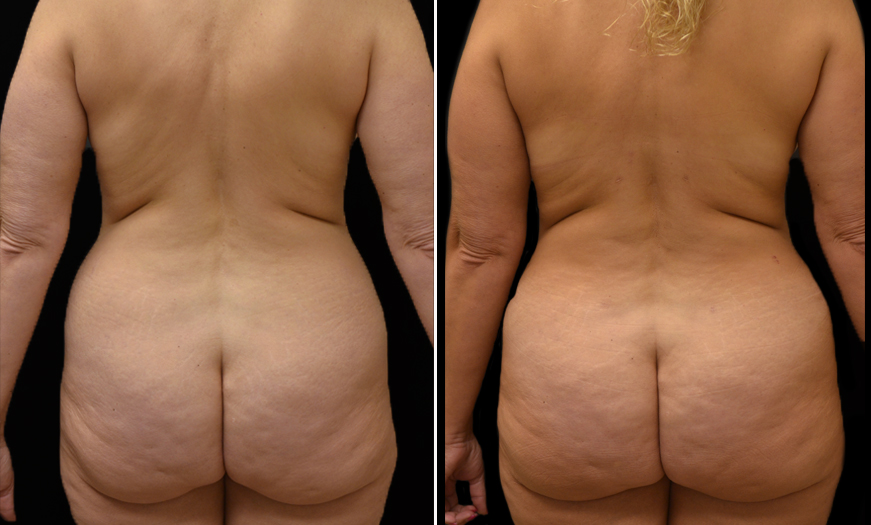 Abdominoplasty Before & After