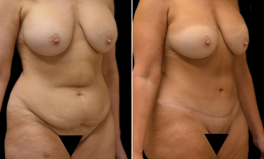 Before and After Abdominoplasty