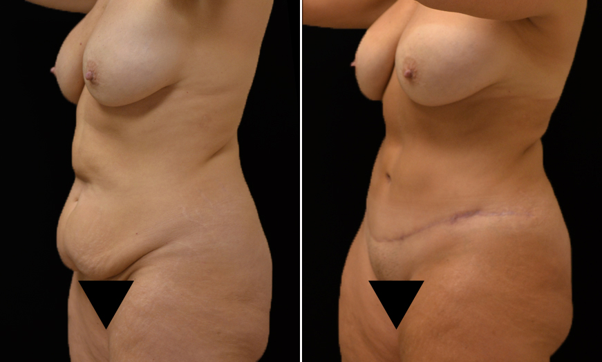 Before & After Abdominoplasty