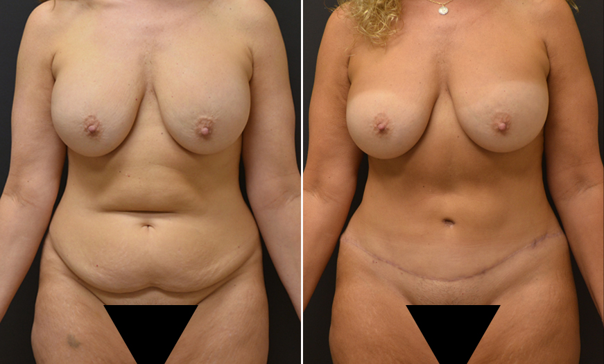 VASER Liposelection Before and After