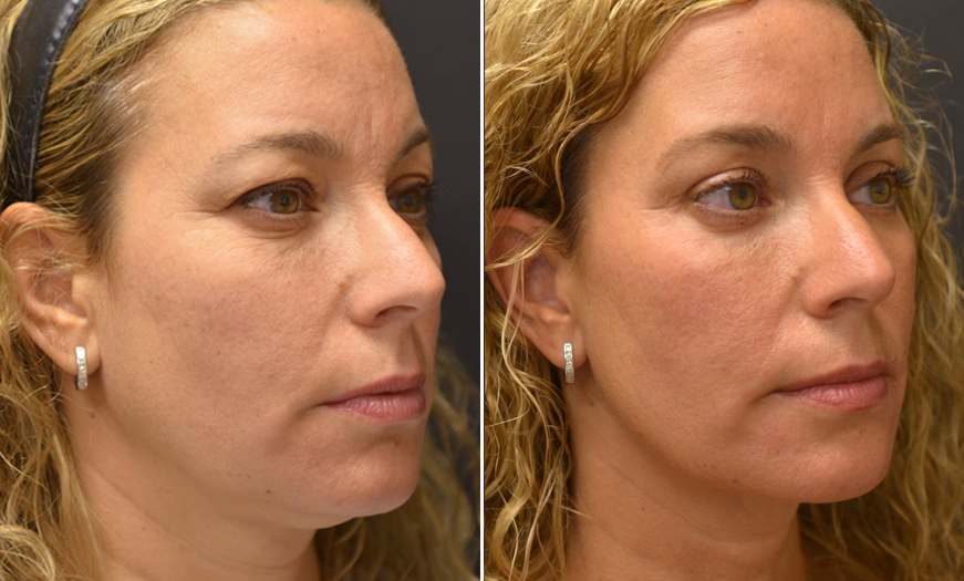 Blepharoplasty Before and After Image