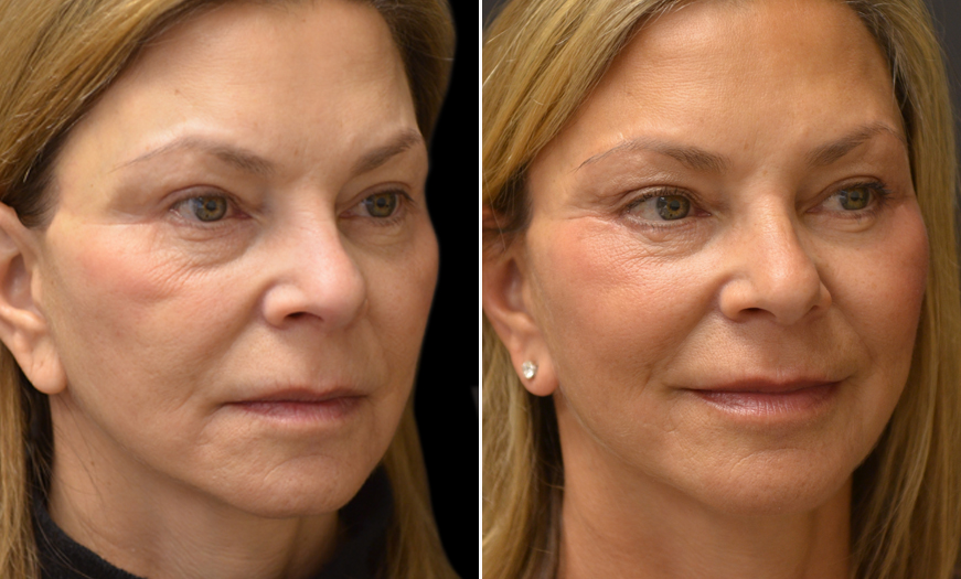 Eyelid Surgery Before and After