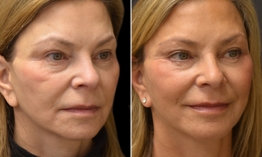 Before and After Malar Bags Treatment in NJ