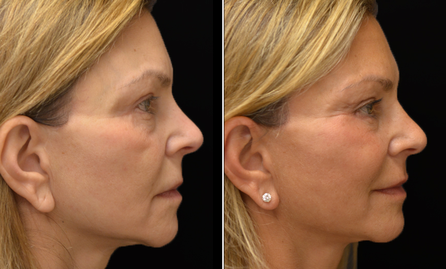 Before & After Malar Bags Treatment in NJ