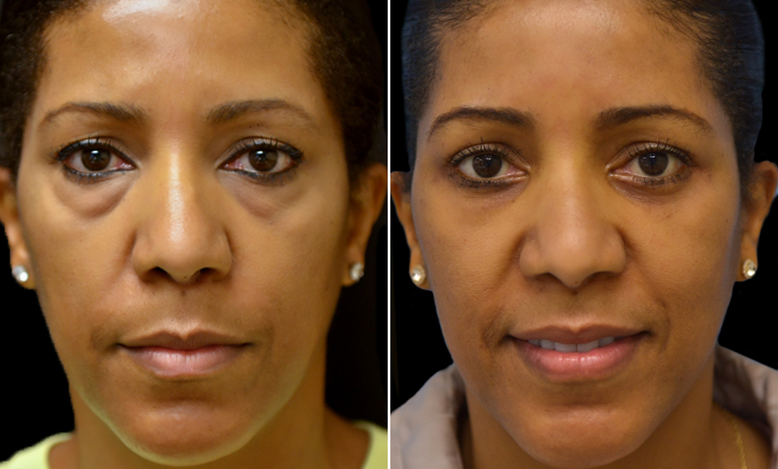 Eyelid Surgery Results