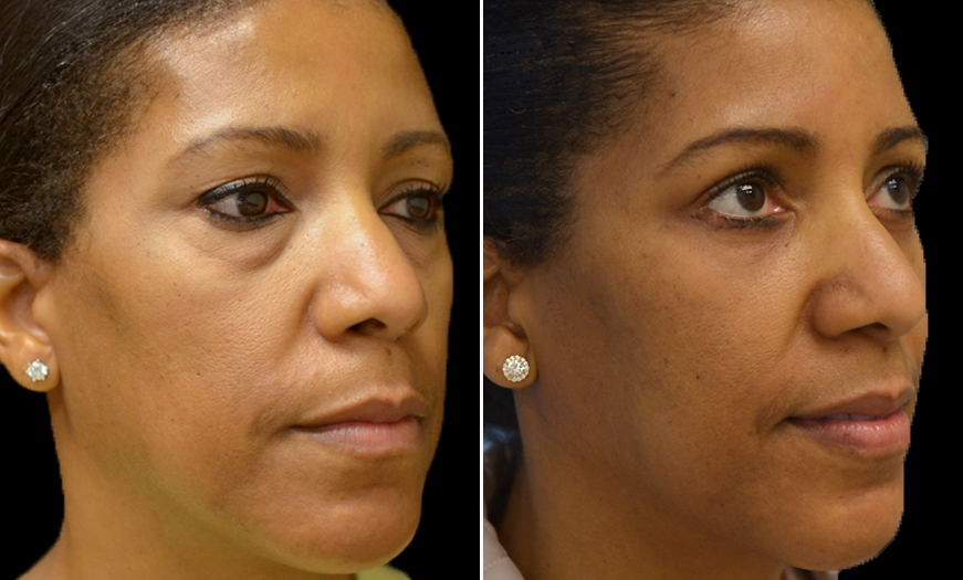 Eyelid Surgery Results Before and After
