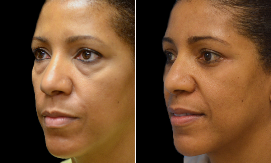 Eyelid Surgery Results Before & After