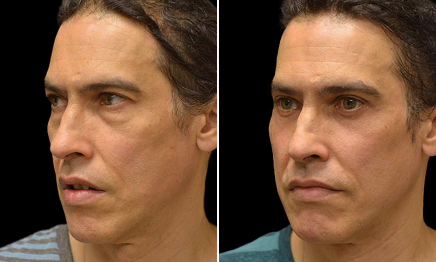 Lower Blepharoplasty Before and After