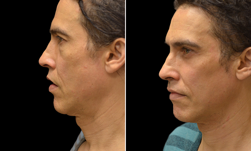 Lower Blepharoplasty Before & After