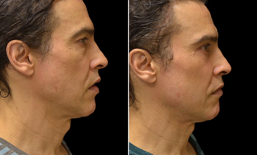 Before and After Malar Bags Treatment in New Jersey