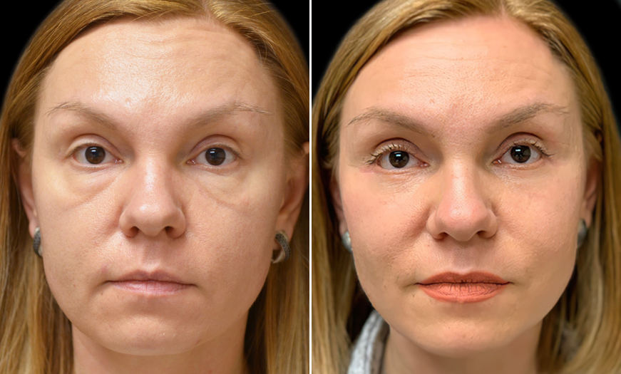 Blepharoplasty and Festoons Before and After