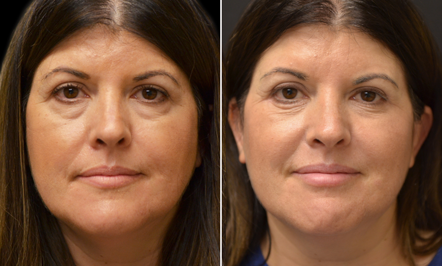 Blapharoplasty and Botox Before and After