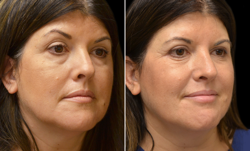 Blapharoplasty & Botox Before & After