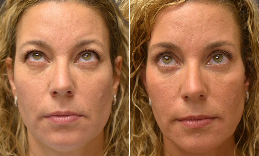 Blepharoplasty and Abdominoplasty Before and After