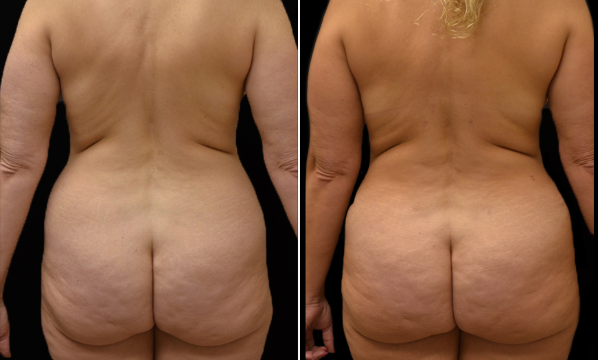 VASER Liposelection Before and After Results