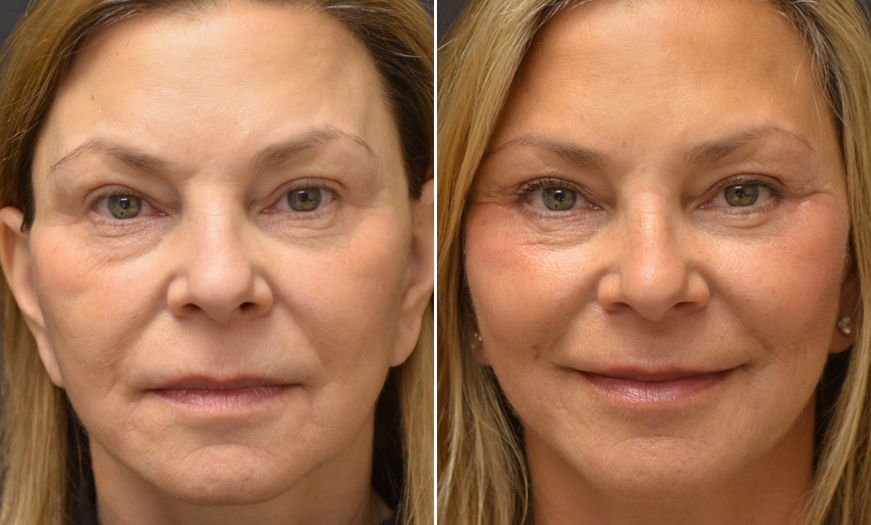Festoons and Blepharoplasty Before and After