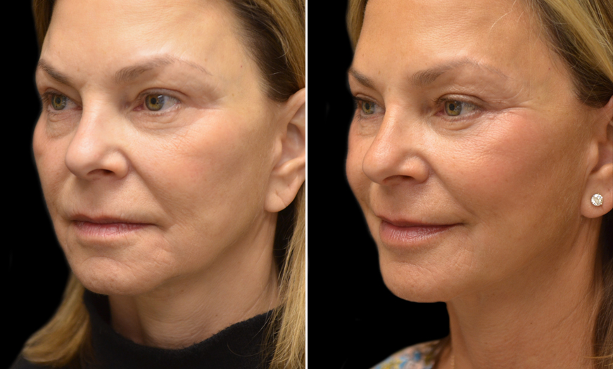 Festoons & Blepharoplasty Results