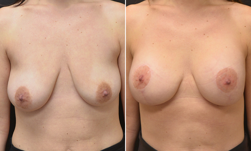 Mastopexy Treatment Before And After In New Jersey