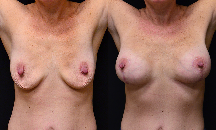 New Jersey Mastopexy Treatment Before And After 