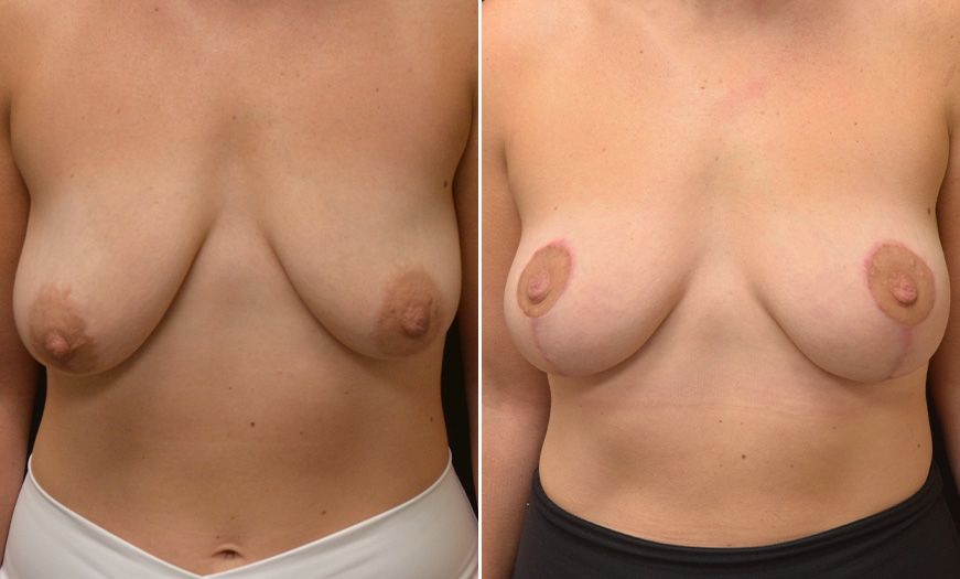 Breast Lift Treatment Before And After In New Jersey