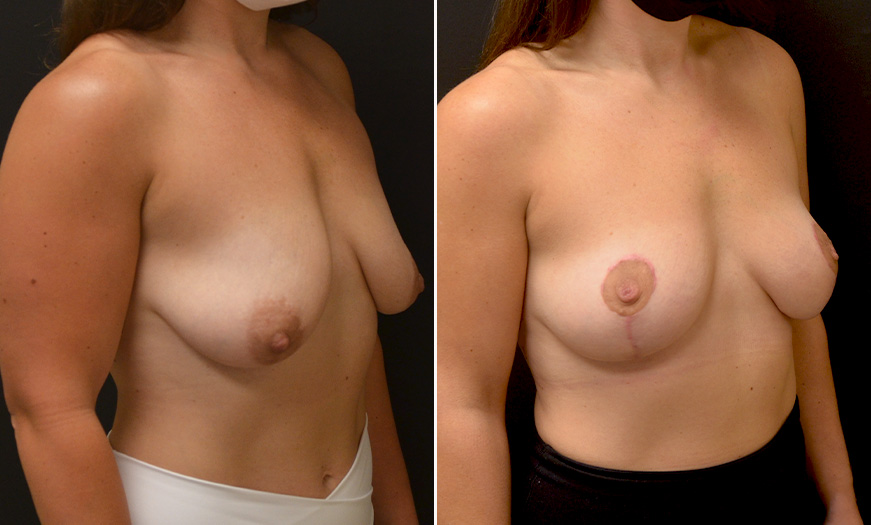 Mastopexy Treatment Before & After In New Jersey
