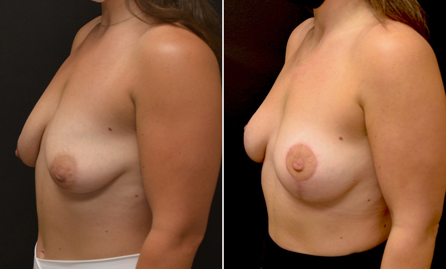 Breast Lift Surgery Results In New Jersey