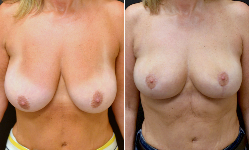 Mastopexy Surgery Before & After In New Jersey