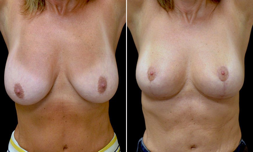 Mastopexy Surgery Before And After In New Jersey