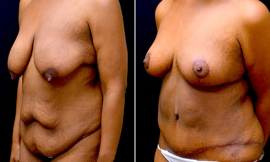 Before & After Breast Lift In New Jersey