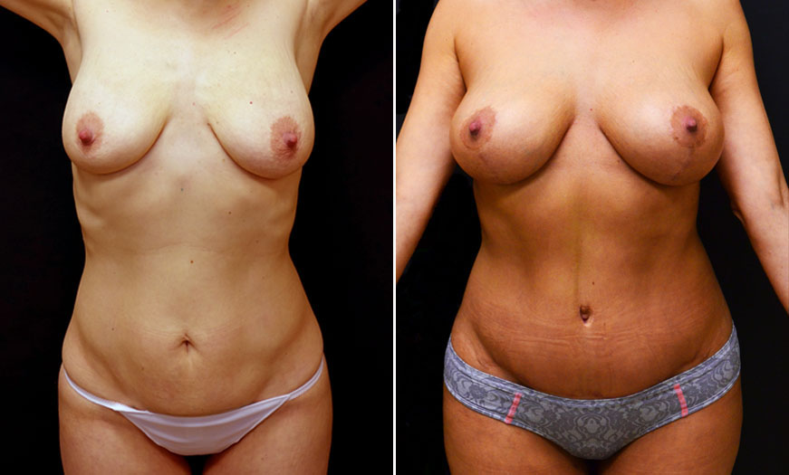 Before And After Mastopexy In New Jersey