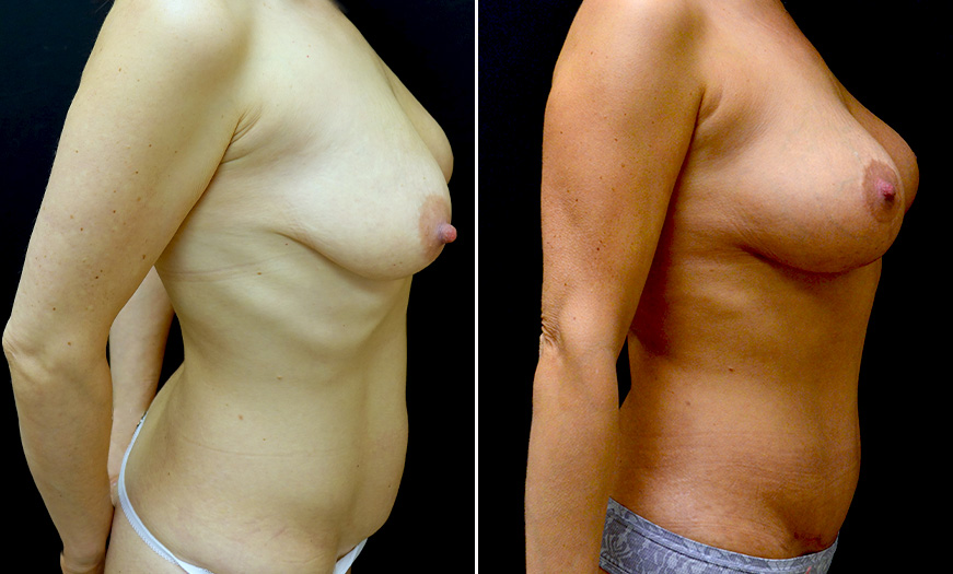 Breast Lift Treatment Results In New Jersey