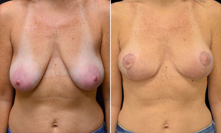 Before & After Breast Lift Treatment In New Jersey