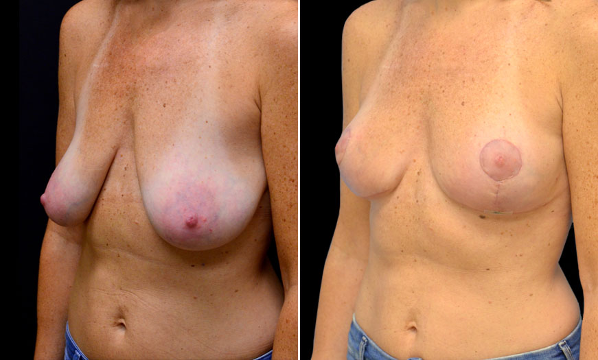 Before And After Breast Lift Treatment In New Jersey