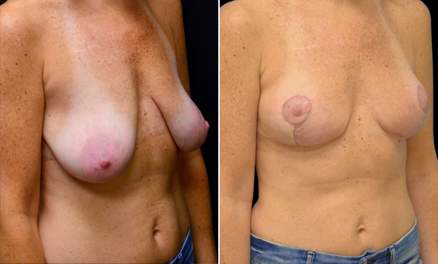 Breast Lift Treatment Before & After In New Jersey