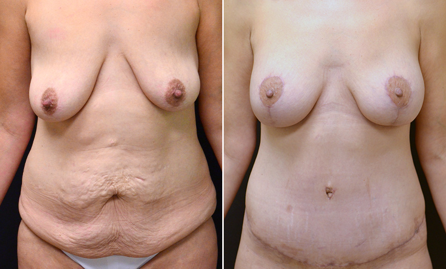 New Jersey Abdominoplasty Surgery Before And After