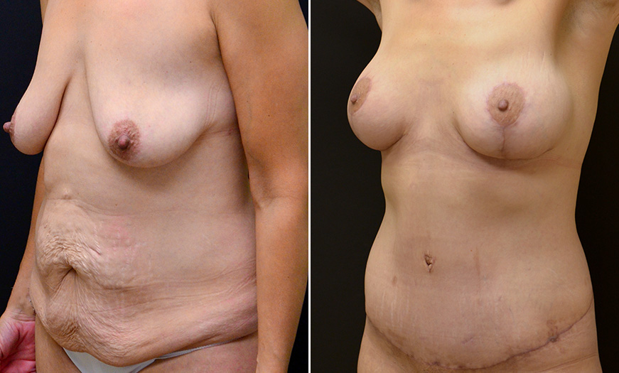 New Jersey Abdominoplasty Results