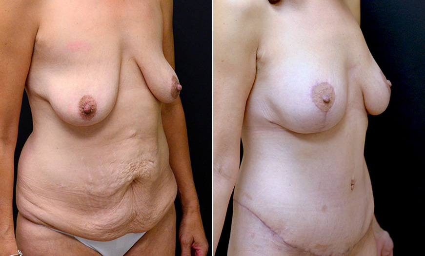 Before & After Abdominoplasty In New Jersey