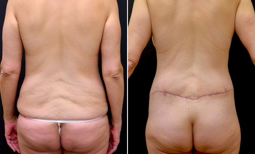 Before And After Abdominoplasty In New Jersey