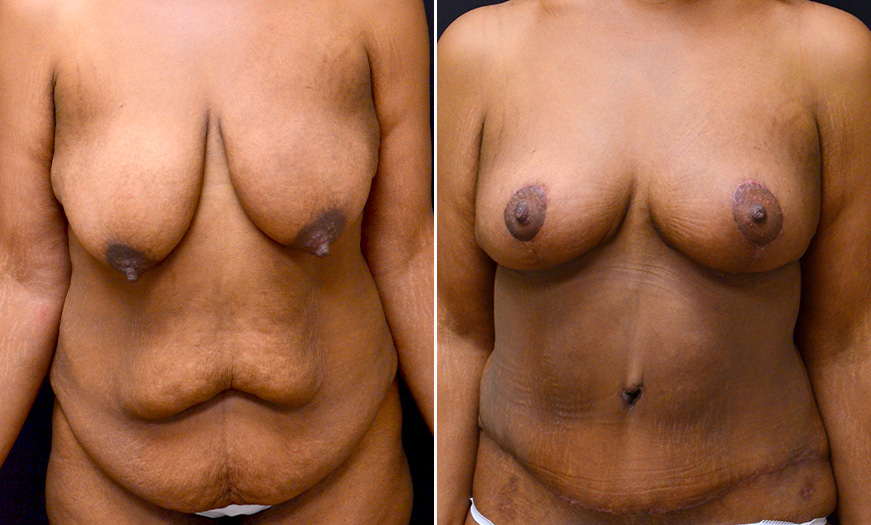 New Jersey Abdominoplasty Treatment Before And After