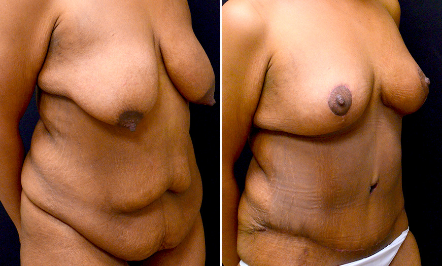 Before & After Abdominoplasty Surgery In New Jersey