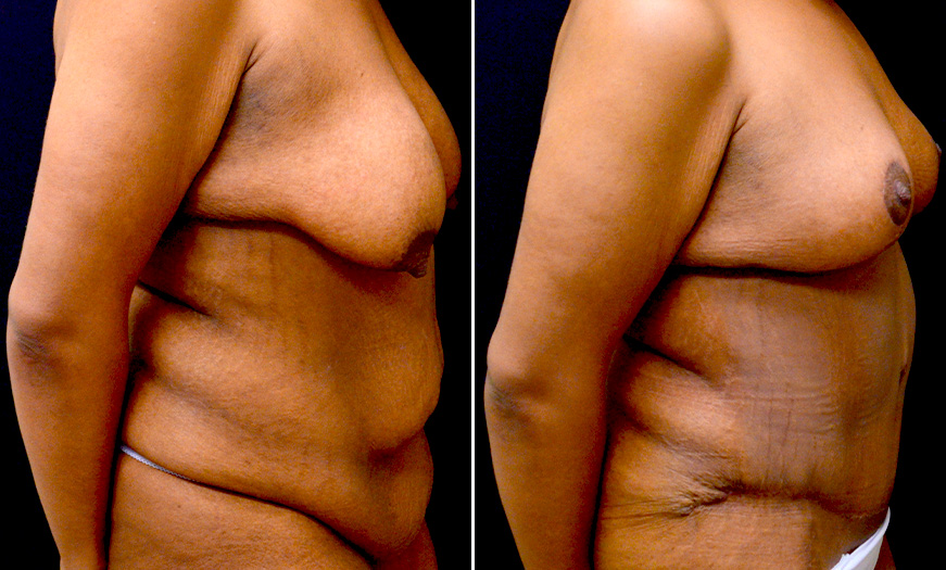 Before And After Abdominoplasty Surgery In New Jersey