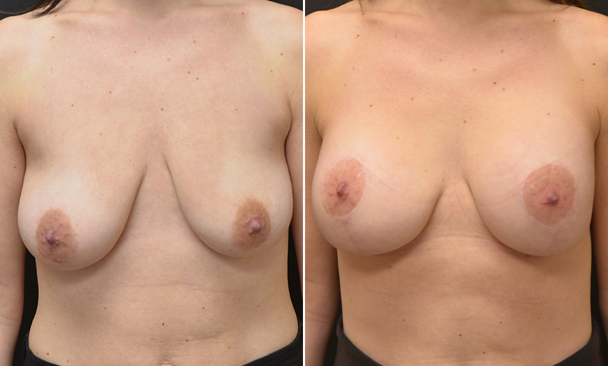 Breast Implant Treatment Results