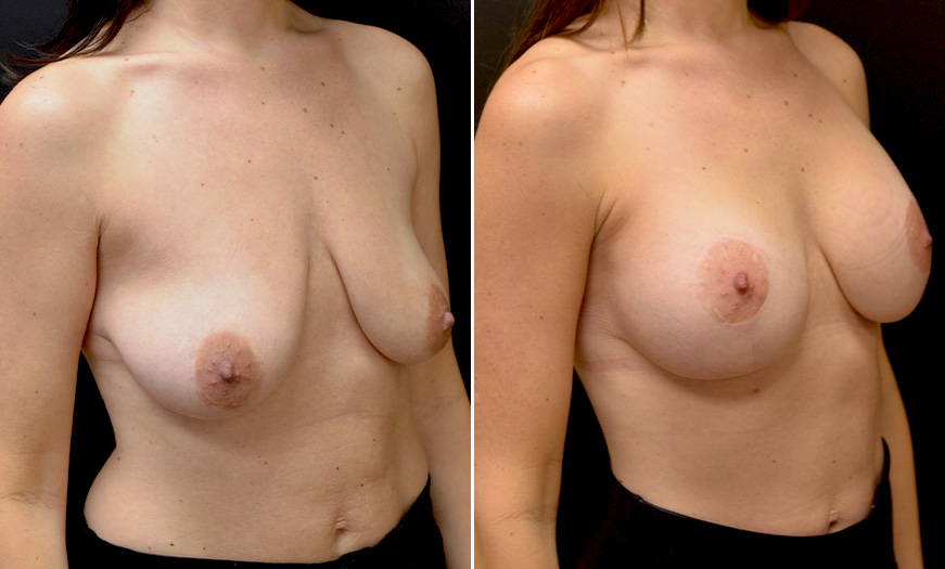 Breast Implant Treatment Before & After