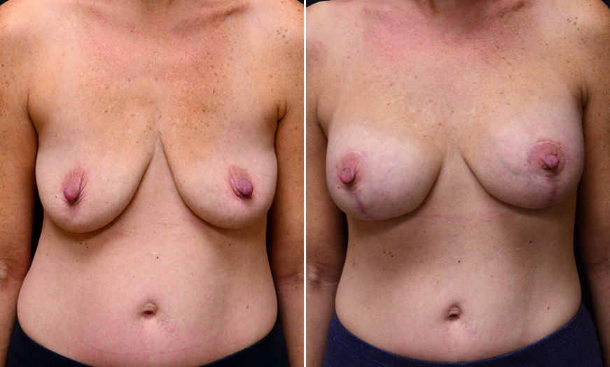 Breast Implant Treatment Before And After