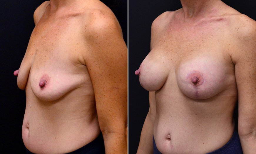 Before & After Breast Implant Surgery